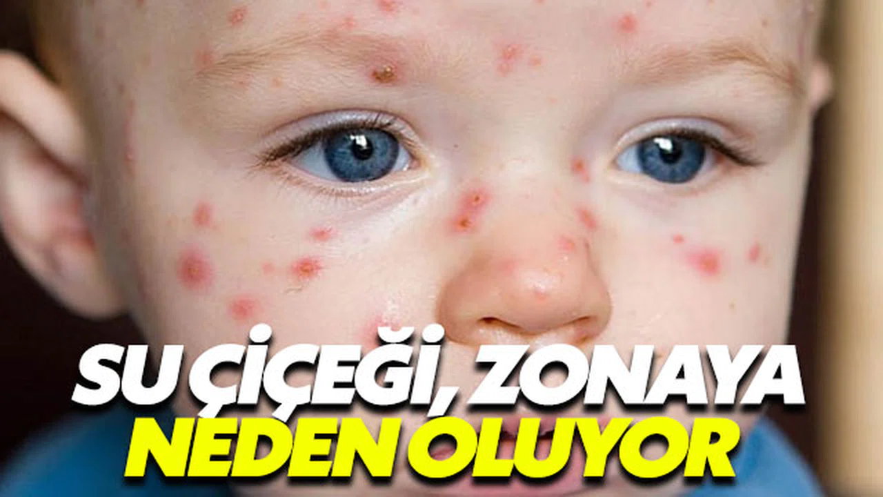 Suçiçeği virüsü vücutta gizlenip zonaya sebep oluyor