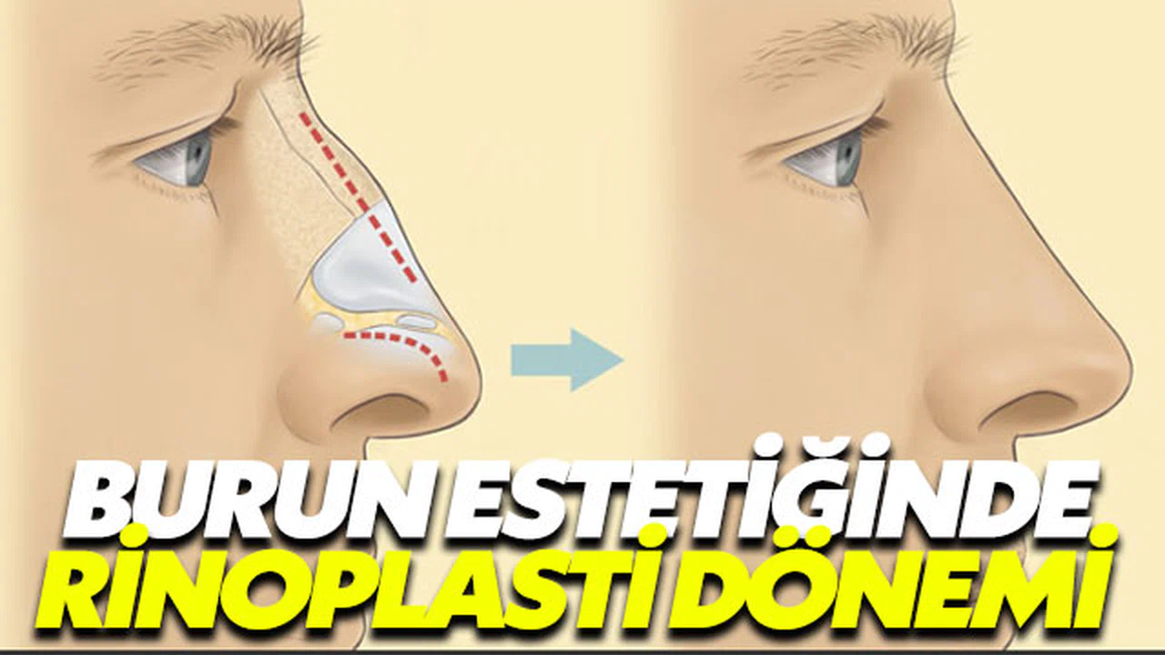Burnunuzdan memnun değilseniz rinoplasti ameliyatını düşünmelisiniz