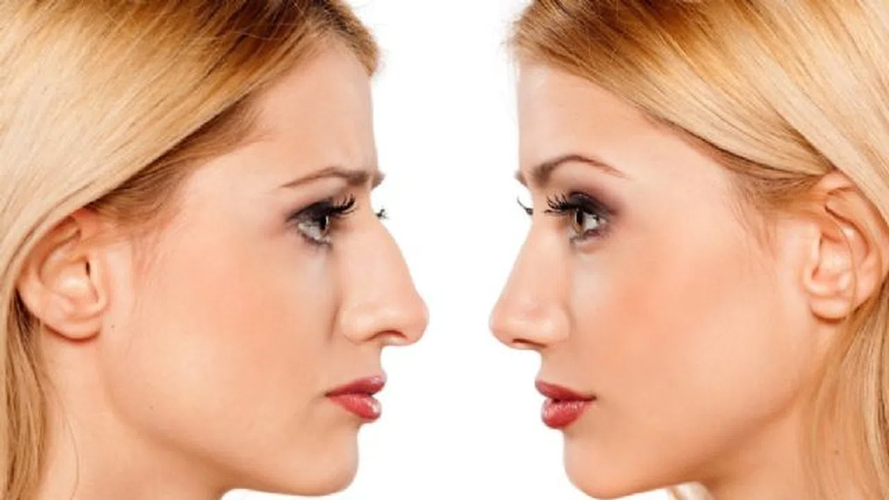 Burun ameliyatı öncesi bunlara dikkat