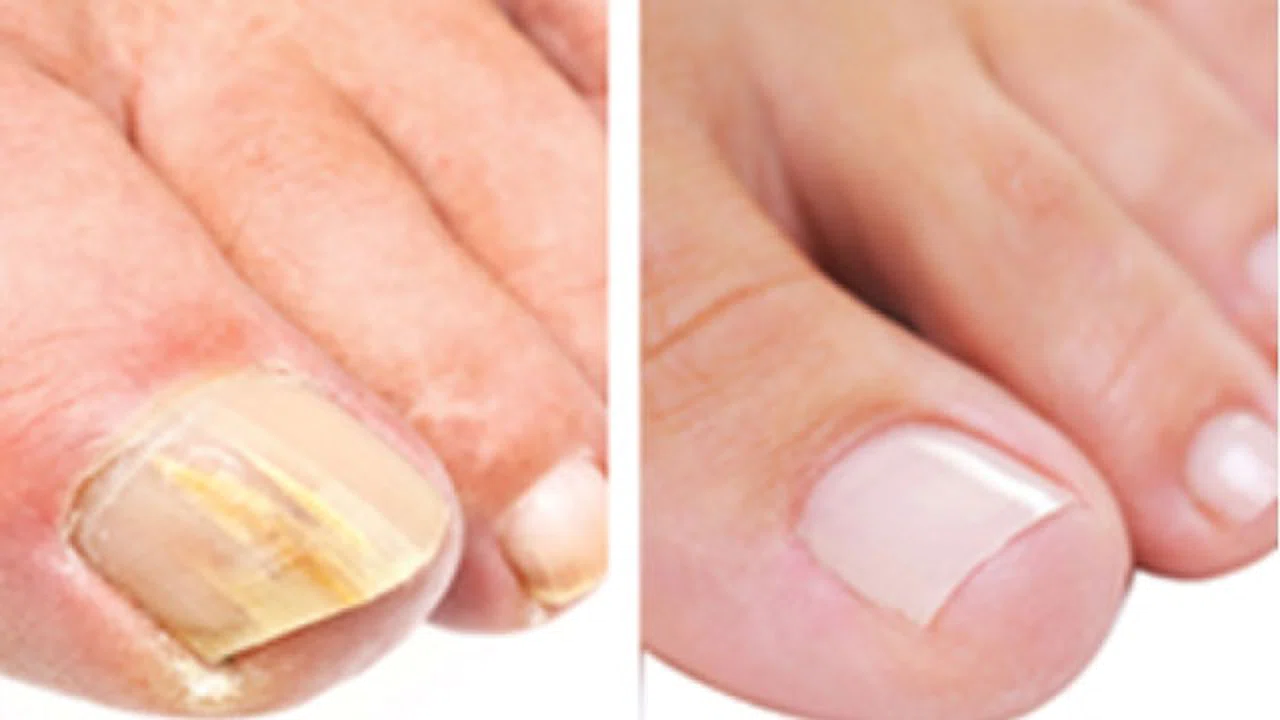 Tırnak mantarıyla mücadele mümkün