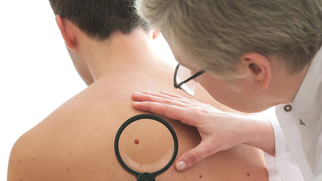 Vücudunuzdaki benin tehlikeli olup olmadığını nasıl anlarsınız?