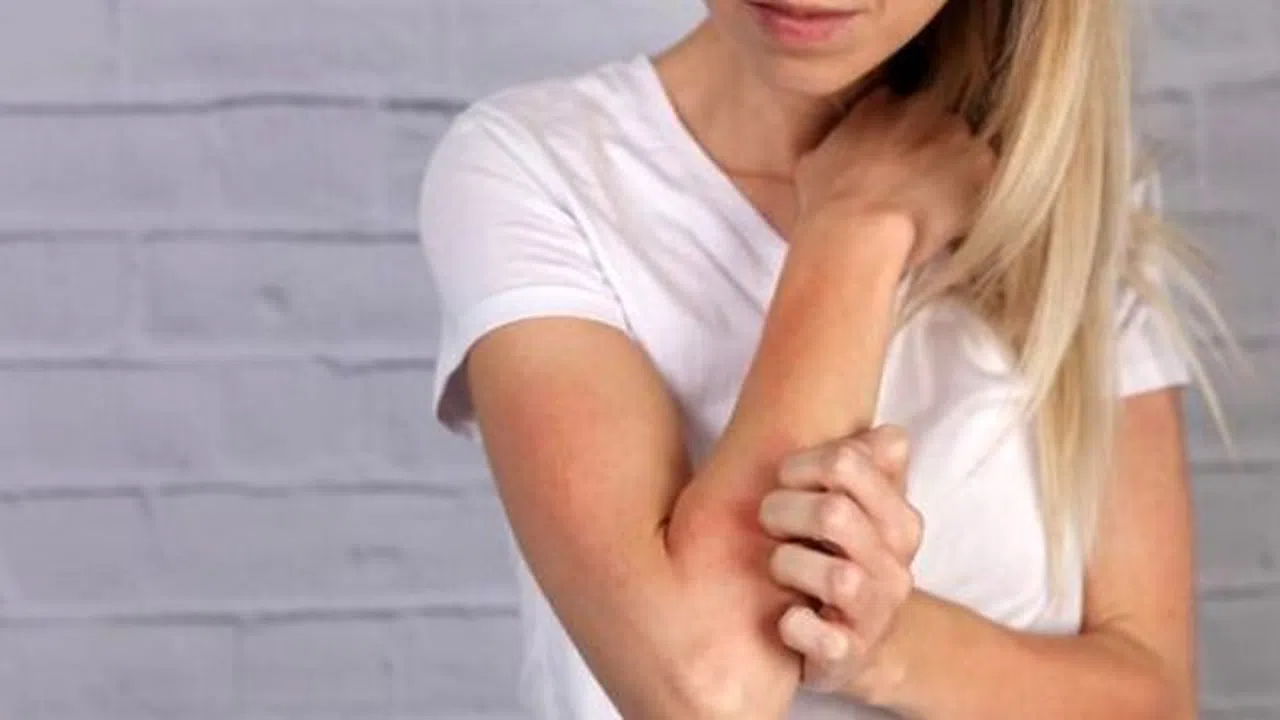 Uyuz hastalığına dikkat!