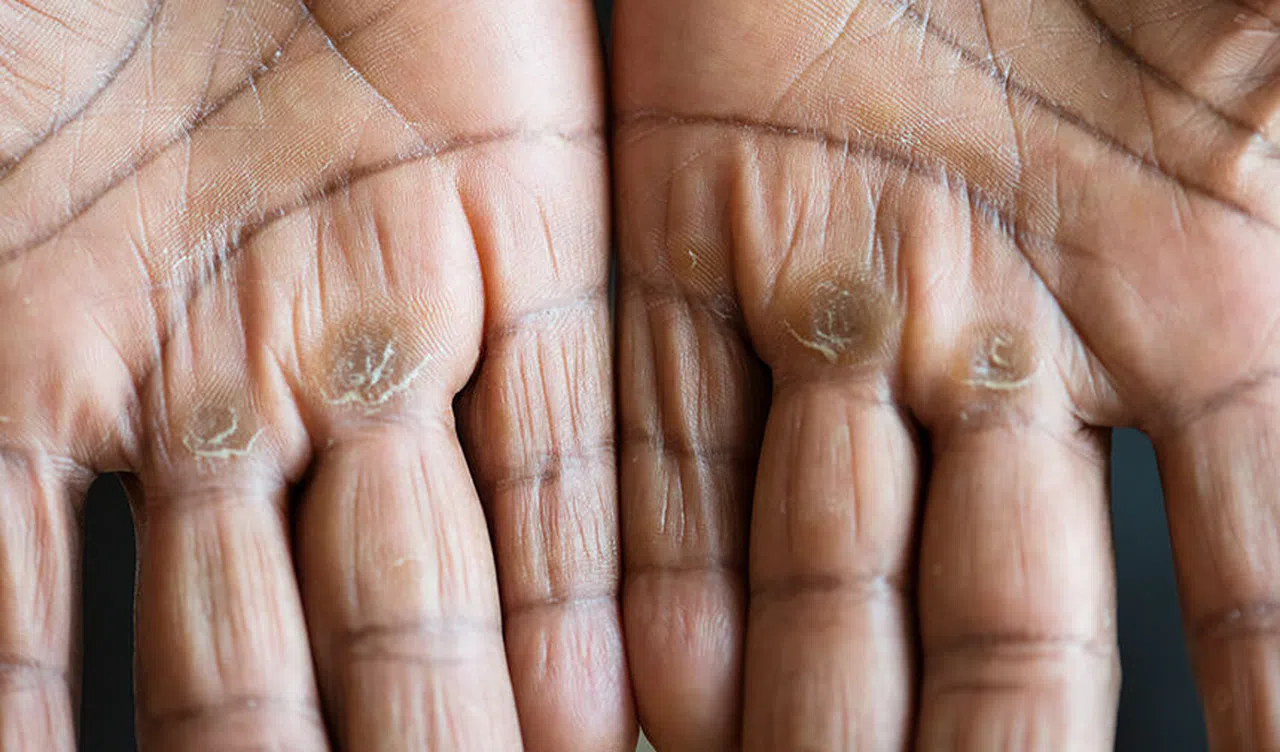 Eller Kanserde Erken Belirtilerin Habercisi Olabilir