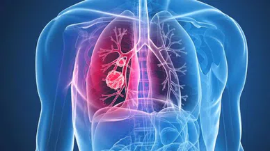 Kanser Hastalığının Önlenemeyen Artışı