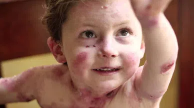 Haluk Levent Kelebek Hastası Elfida Gündüz'ü İzmir'de ziyaret etti