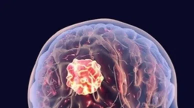 Beyin Tümörleri Hakkında En Çok Merak Edilen 5 Soru