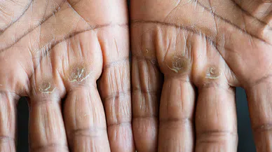 Eller Kanserde Erken Belirtilerin Habercisi Olabilir