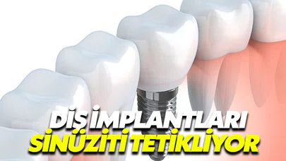 Diş implantları sinüziti tetikliyor