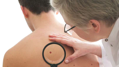 Vücudunuzdaki benin tehlikeli olup olmadığını nasıl anlarsınız?