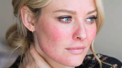 Rozasea hastalığının altında başka hastalıklar yatıyor olabilir