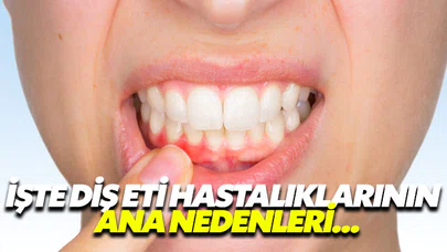 İşte diş eti hastalıklarının ana nedenleri