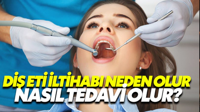 Diş Eti İltihabı Neden Olur, Nasıl Tedavi Edilir?