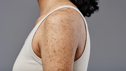 Cilt Lekeleri Hangi Hastalığın Belirtisi