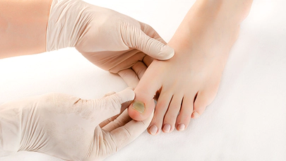 Ayak Mantarı, Oluşumu ve Tedavi Yöntemleri