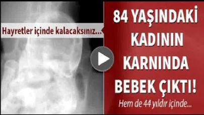 60 Yıl Hamile Kaldıktan Sonra Taş Bebek Doğurdu
