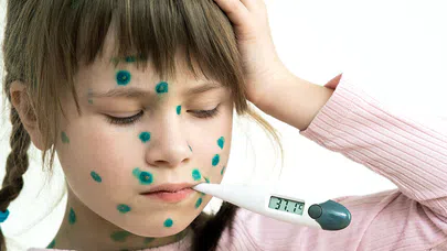 Çocuklarda Beşinci Hastalık ve Önlemler