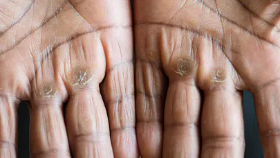 Eller Kanserde Erken Belirtilerin Habercisi Olabilir