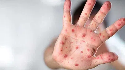 Maymun Çiçeği Virüsü Hakkında Merak Edilenler