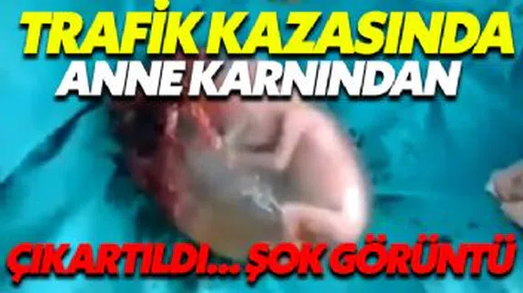 Trafik Kazasında Anne Karnından Çıkartılan Canlı Cenin...