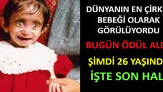 Dünyanın en çirkin bebeği olarak biliniyordu... Bakın Şimdi Nasıl...