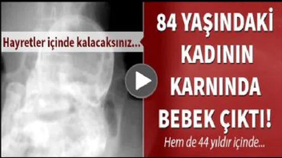 60 Yıl Hamile Kaldıktan Sonra Taş Bebek Doğurdu