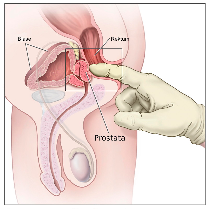 prostatkanseriteshisi-2